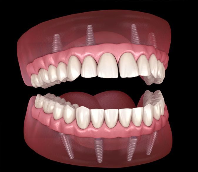 Protezas su metalo karkasu ir akriliniais dantimis