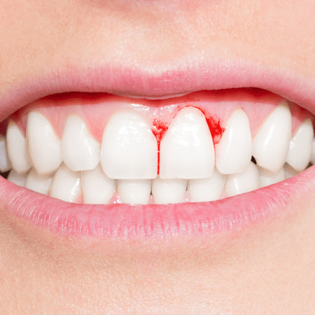 Kraujuojančios dantenos